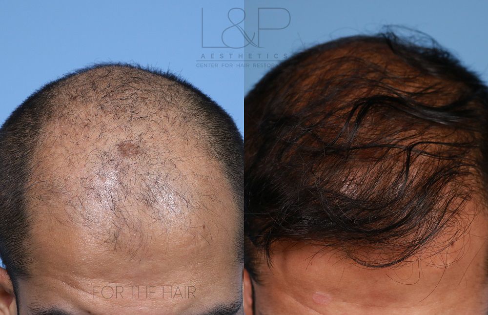 case-20 - Hair Transplant & Restoration | San Francisco Bay Area & Palo  Alto | Drs. Lieberman & Parikh
